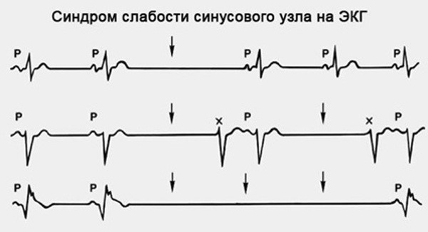синдром синдром